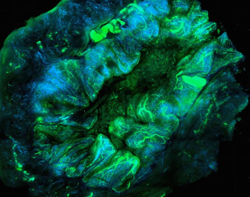 Can Enhertu Treat Ovarian Cancer? All the Data, None of the Hype.